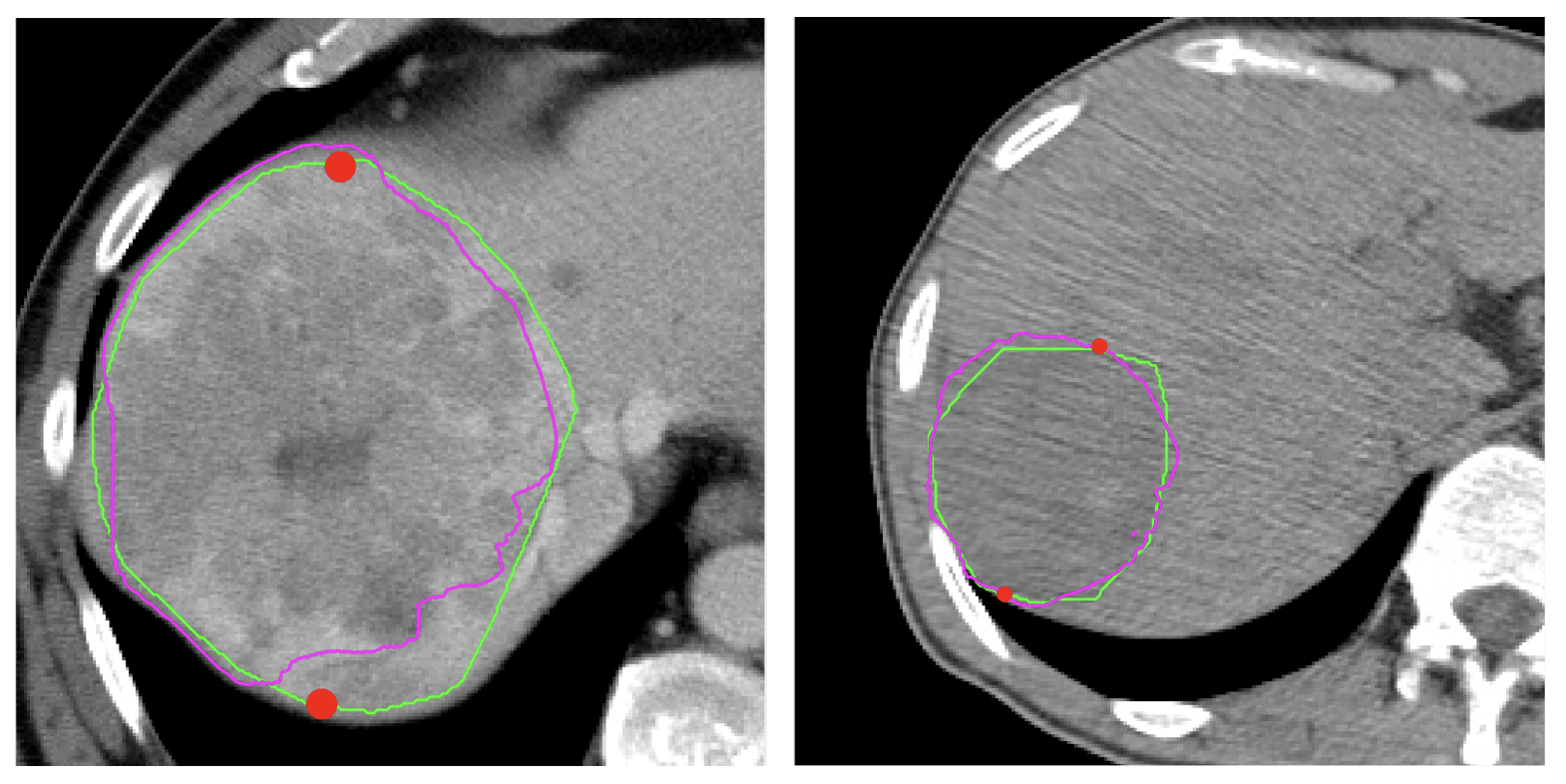 nips2016-lesion-segmentation.png